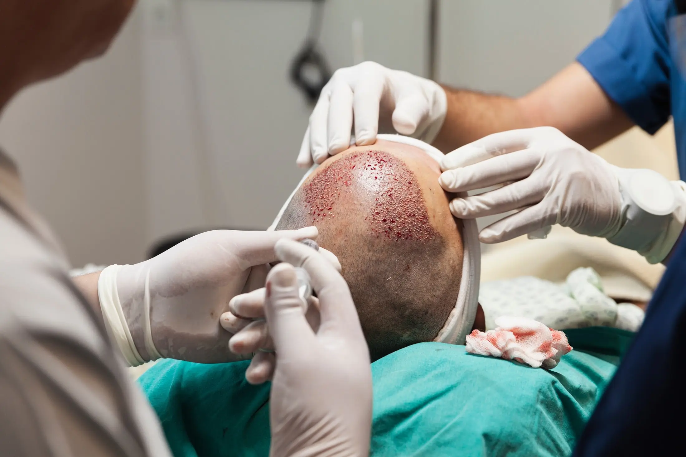 hair-transplant-surgery-min